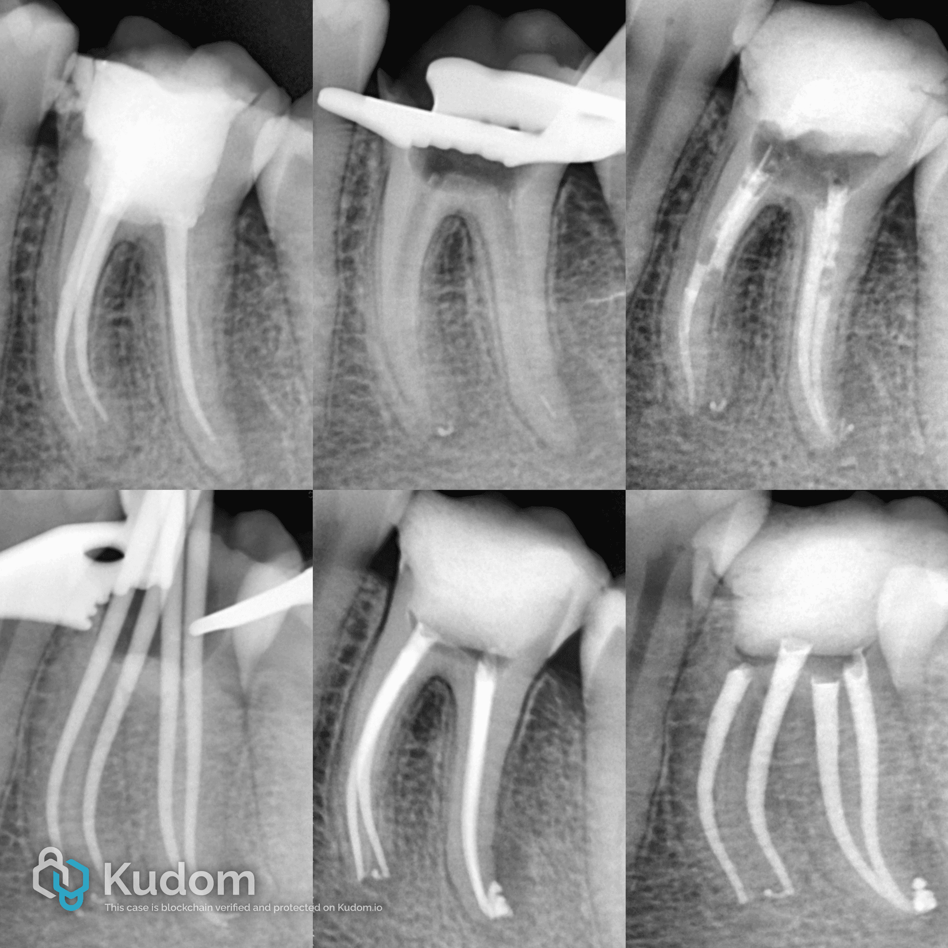 Rct Fail Kudom | Retreatment of failed previos RCT